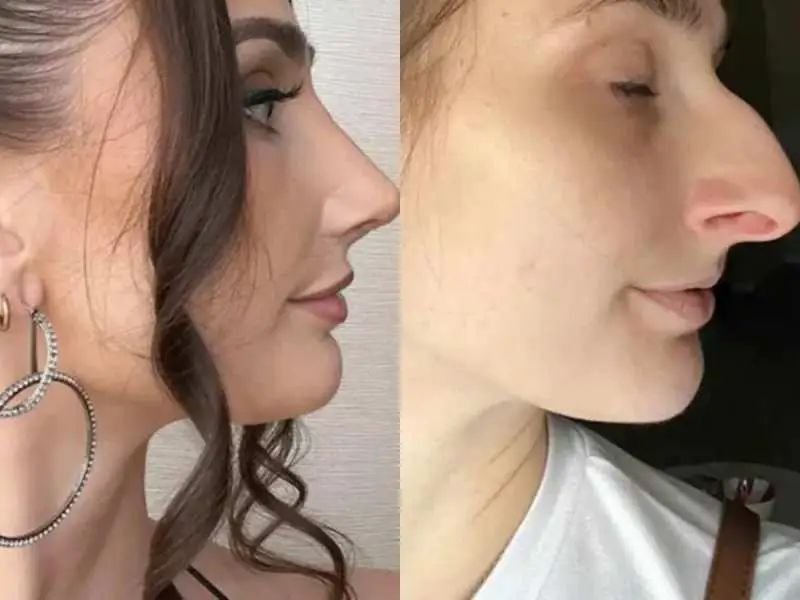 9 लाख रुपये लेकर करवाई नाक की सर्जरी, 'खूबसूरत' दिखने लगी तो पत्नी ने पति को दे दिया तलाक