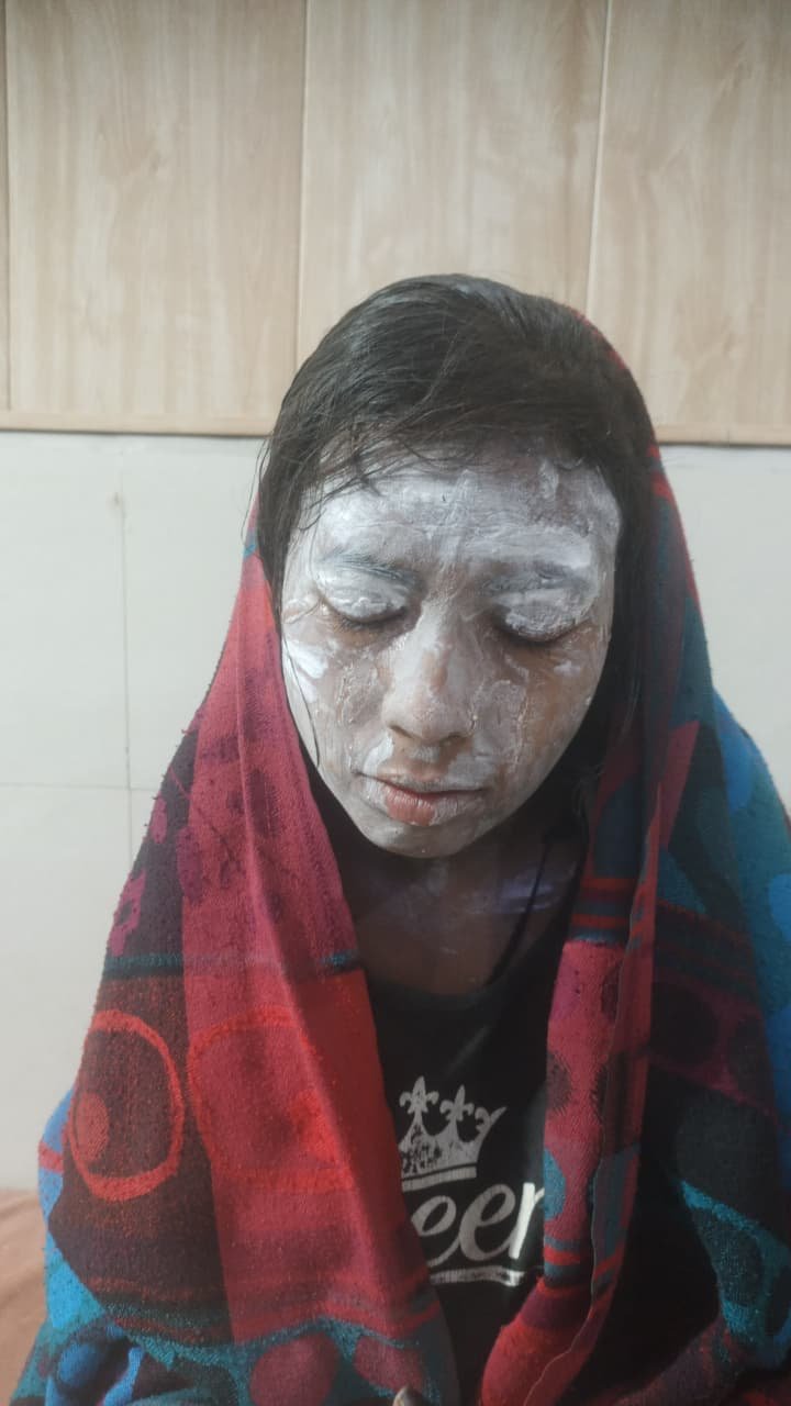 रायबरेली-खाना बनाते समय फटा प्रेशर कुकर, किशोरी झुलसी, हुई गंभीर रूप से घायल