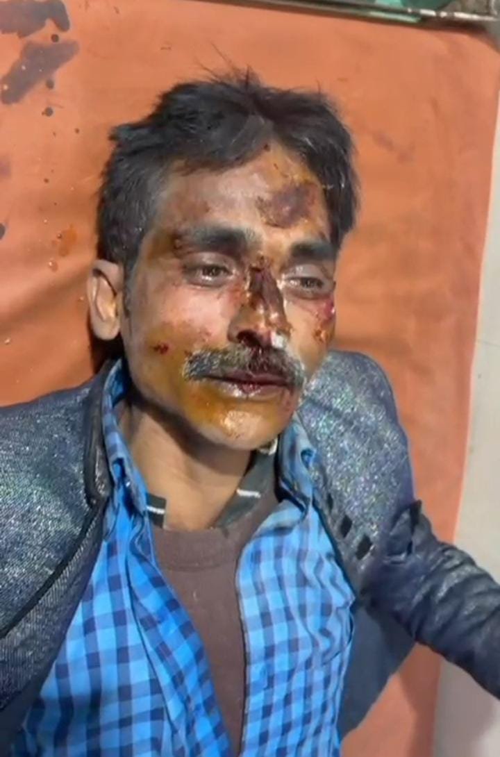 रायबरेली-स्कूटी सवार सभासद प्रतिनिधि को अज्ञात वाहन ने मारी जोरदार टक्कर, घायल