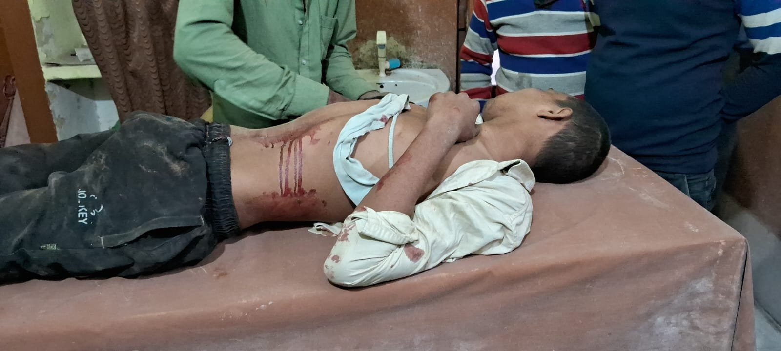 रायबरेली-चक्की में युवक का कड़ा फसने से युवक का कटा हाथ