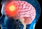 ब्रेन स्ट्रोक क्यों आता है? इसके लक्षण दिखने के बाद सबसे पहले क्या करें