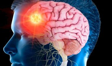 ब्रेन स्ट्रोक क्यों आता है? इसके लक्षण दिखने के बाद सबसे पहले क्या करें