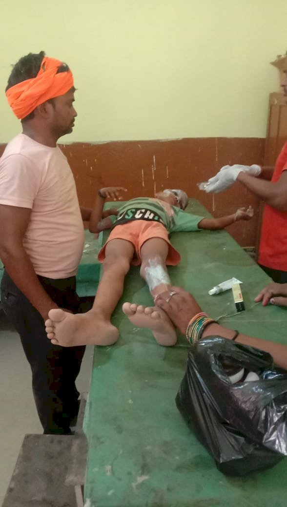 Raibareli-पटाखा दगाते समय मासूम झुलसा 